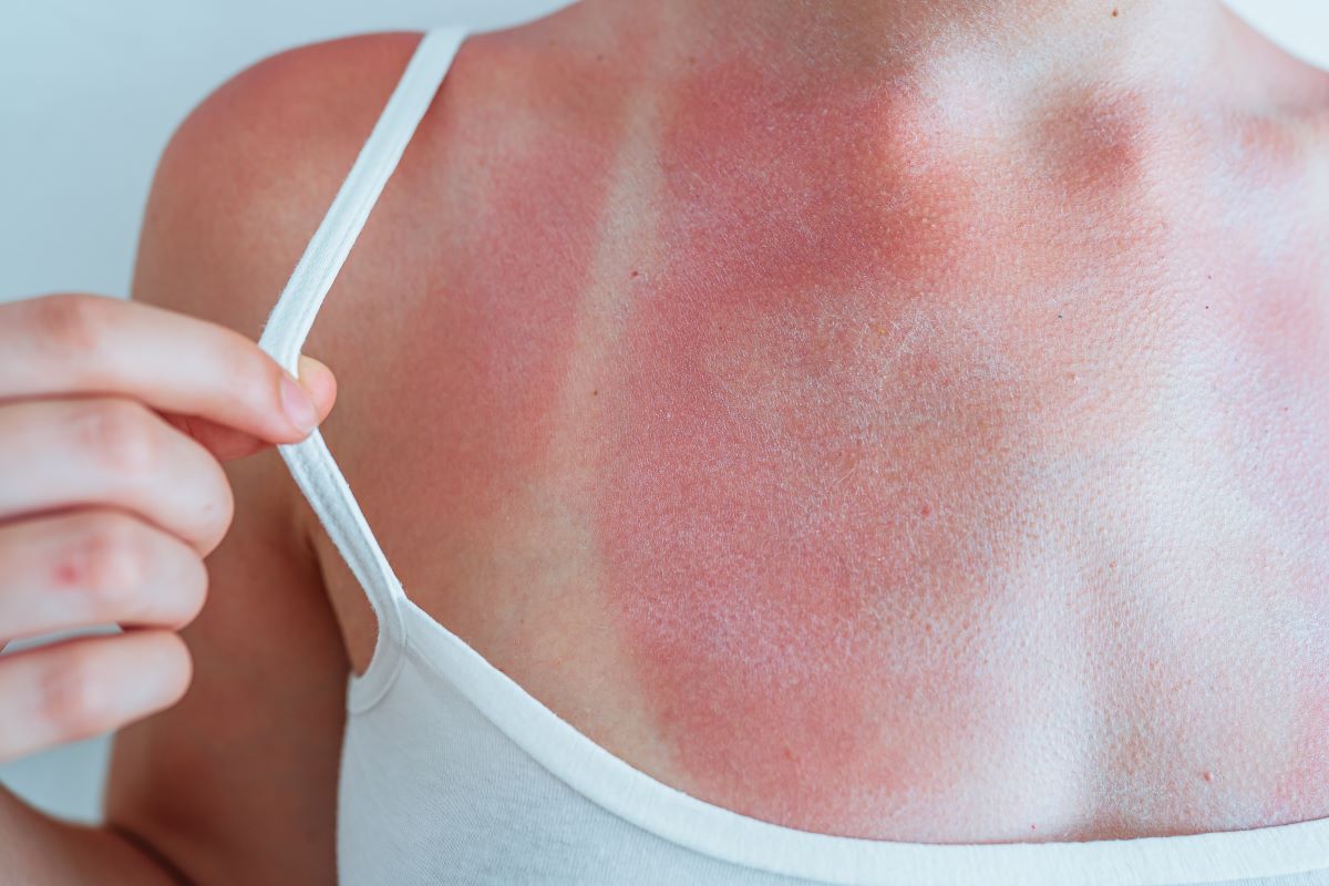 Sonnenbrand in Lörrach vermeiden und richtig behandeln – ein